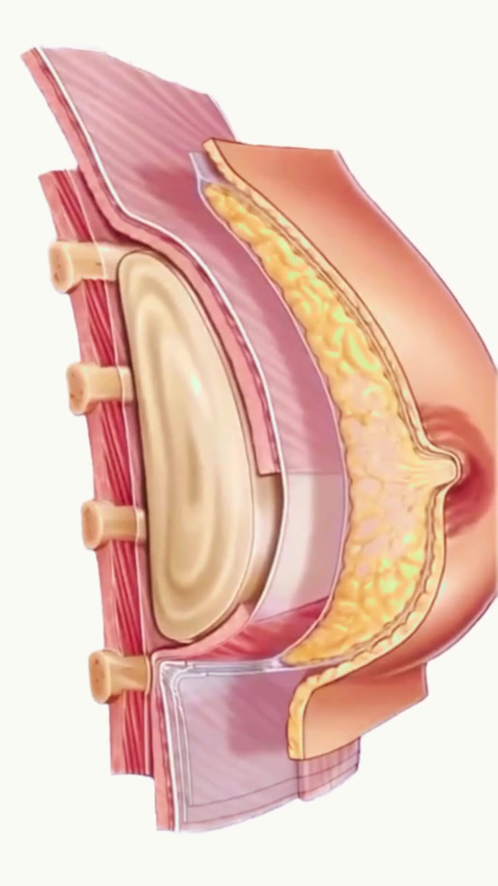 Preview of the Chestnut Technique surgical animation