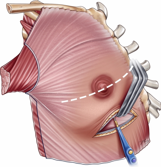 Dissection boundary